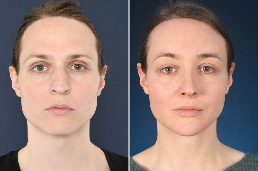 Операция по уменьшению малых. Феминизация before after. Феминизирующая пластика лица. Феминизация лица до и после.