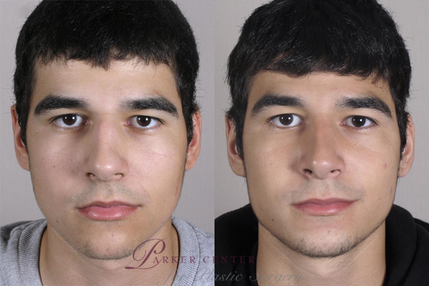 Пластическая операция со скольки лет. Ринопластика до и после мужчины. Выпрямление переносицы. Турецкий нос.