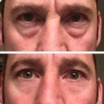 Instantly Ageless cream result - before and after