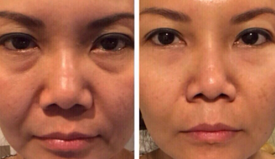 instantly-ageless-photo-before-and-after