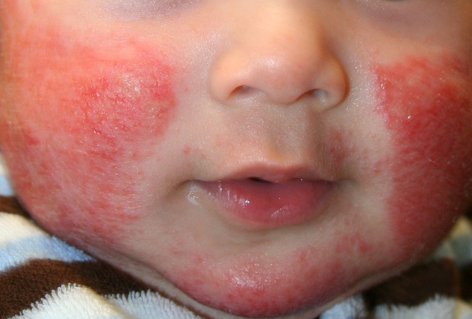 Как быстро убрать сыпь от аллергии на лице