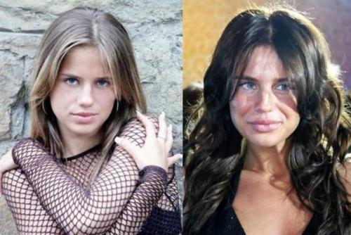 АлексаЮная участница шоу "Фабрика Звезд-4" решила в 23 года стать похожей на своего модного кумира, Анджелину Джоли, для чего уменьшила нос и увеличила губы.