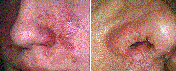 Атопический дерматит (экзема) на носу и вокруг