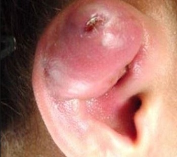 Инфекция пирсинга хряща уха