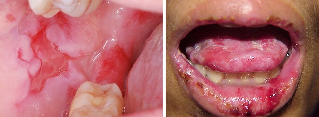 Отслоение слизистой во рту при пемфигусе и пемфигоиде