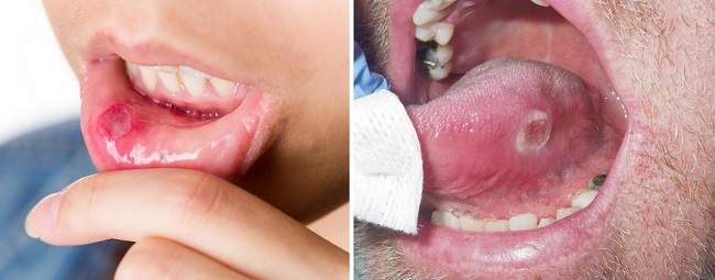 Отслоение слизистой на языке и губе при раке