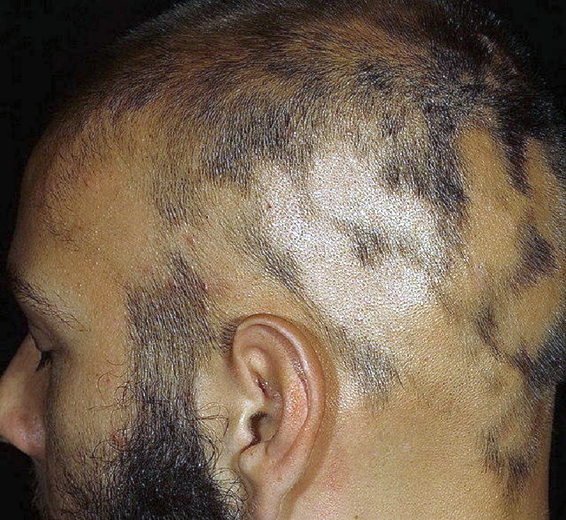Какие гормоны влияют на выпадение и рост волос на голове у женщин: причины нарушений, лечение