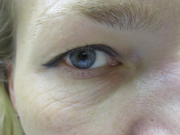 кожа вокруг глаз после 30 лет
