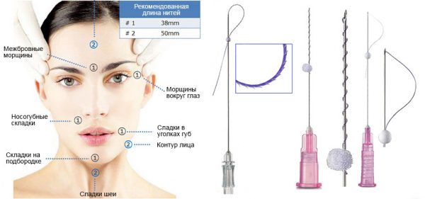 Зоны лица и примеры нитей, применяющихся для нитевого лифтинга