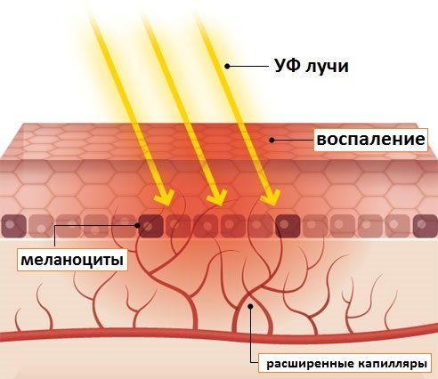 Механизм появления загара