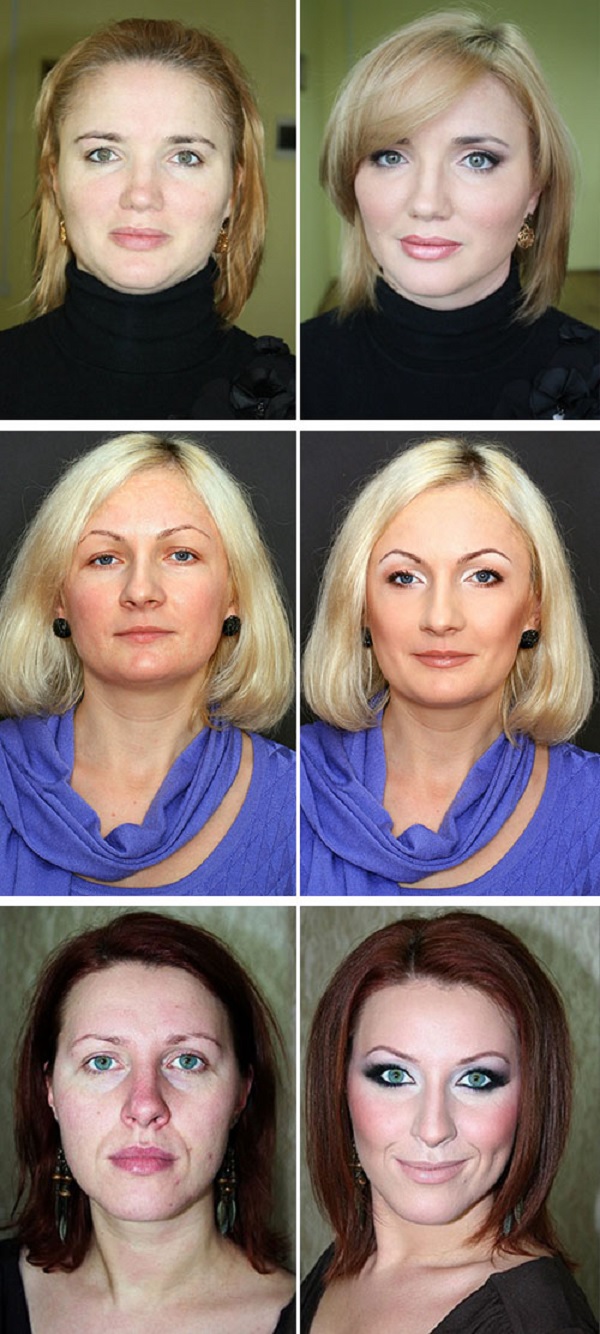 Птоз лица фото после 40 лет