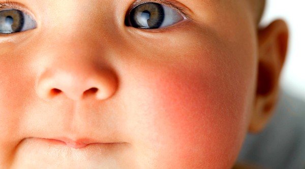 Аллергия на щеках у грудных детей может служить признаком того, что они имеют наследственную предрасположенность к ней