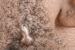 Keloid scar in the beard hair of a man with dark skin