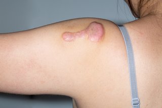 A large keloid scar on a the shoulder of a woman with light skin