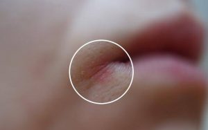 5 e1487273486554 300x188 - Заеды, или трещинки в уголках губ: лечение, профилактика