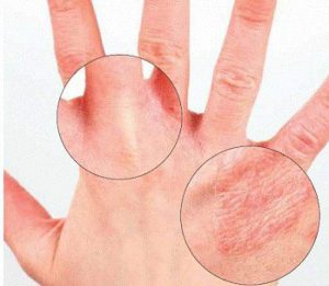 kak otlichit psoriaz ot dermatita 300x261 - Трещины на пальцах возле ногтей: причины, лечение
