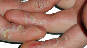treskajutsja ruki do krovi 2 300x165 - Трещины на пальцах возле ногтей: причины, лечение
