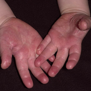 Шелушение кожи на ладонях: причины и профилактика