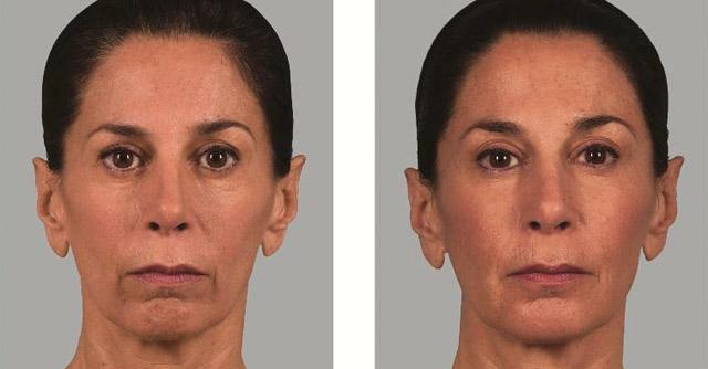 кислородная мезотерапия процедура Oxy Jet Peel