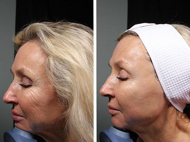 ультразвуковая терапия кожи лица