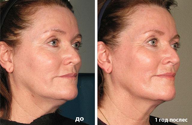 фото до и после ультразвукового лифтинга лица