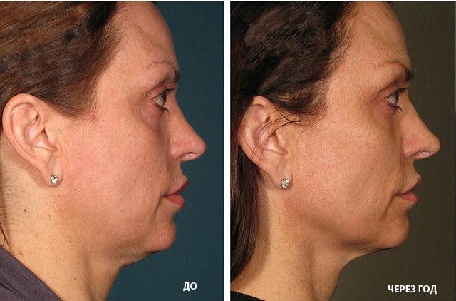 фото до и после ультразвукового лифтинга лица