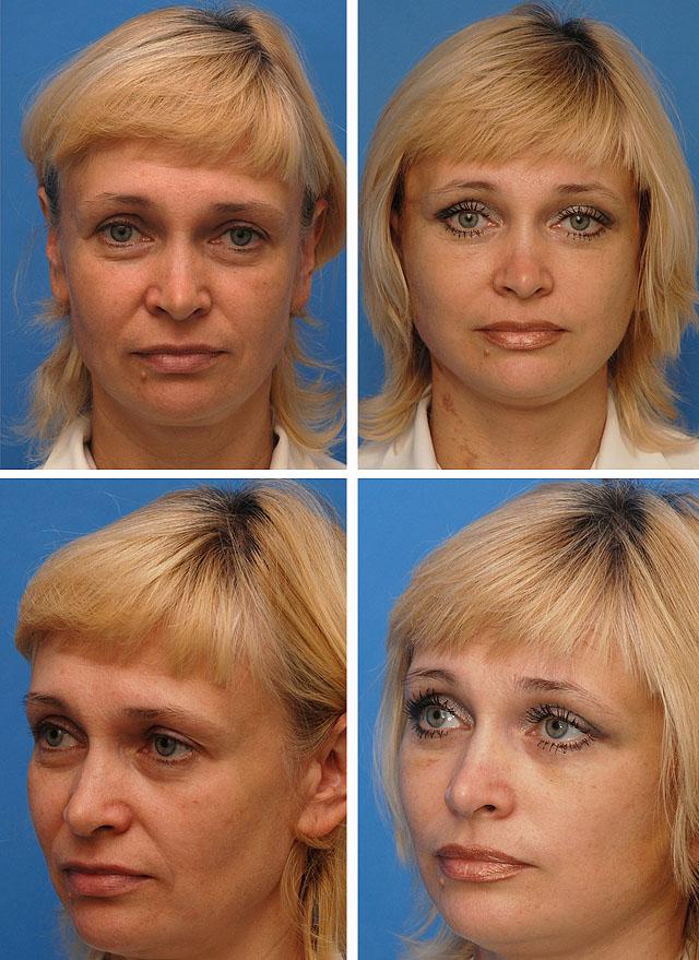 Круговая блефаропластика фото до и после операции