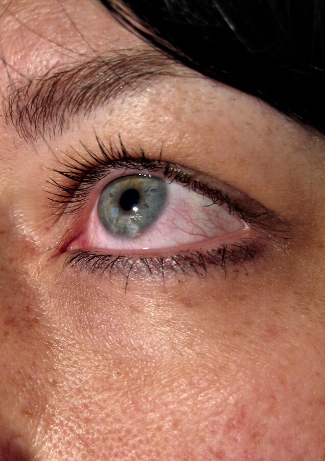 Слезятся глаза на солнце. Блефарит блефароконъюнктивит. Аллергический конъюнктив глаз. Аллергическое воспаление глаз.