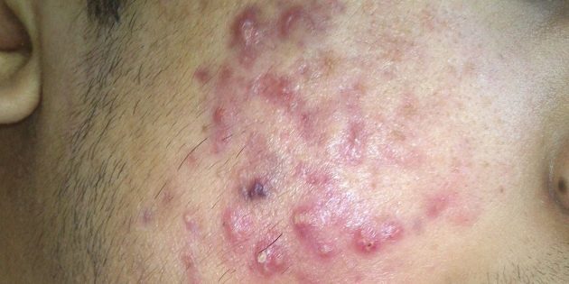 Нодулы, которые могут сливаться в кисты Как избавиться от прыщей: Нодулы, которые могут сливаться в кисты