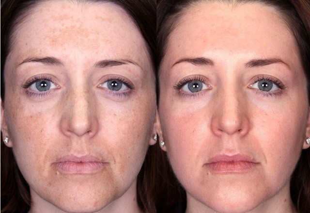 Кислотный пилинг для лица гликолевая кислотой до и после