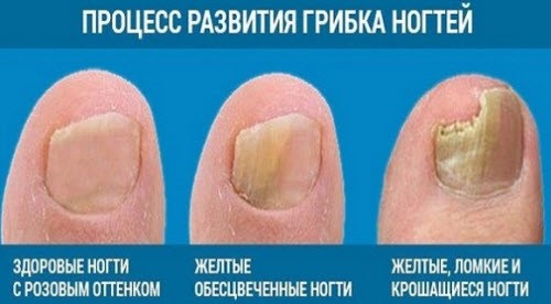Грибок ногтей подробнее на сайте пансионатов "Дача"