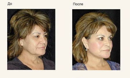 Изменения кожи лица и зоны декольте после применения крема с лифтинг эффектом 