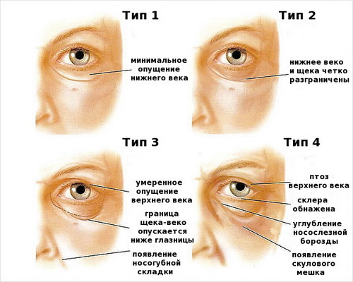 Блефаропластика птоза