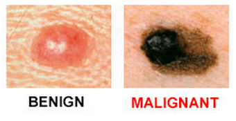 ОПАСНЫЕ РОДИНКИ: 6 признаков меланомы