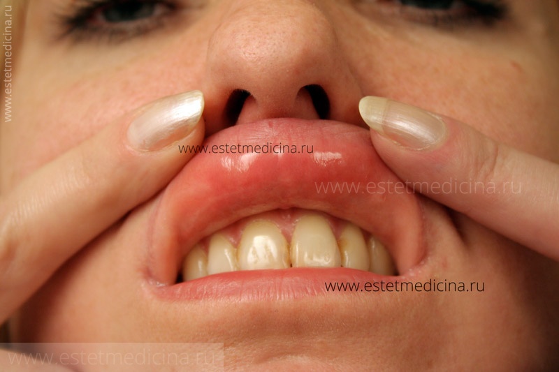 биополимерные губы