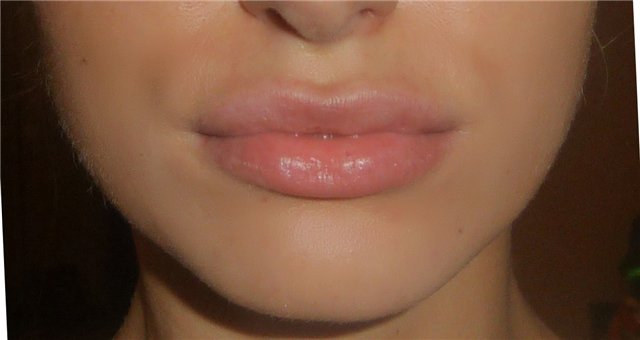 Отзывы о Filorga для увеличения губ