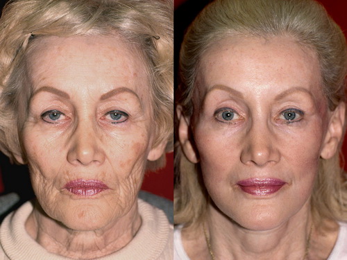 Фото до и после удачных операций