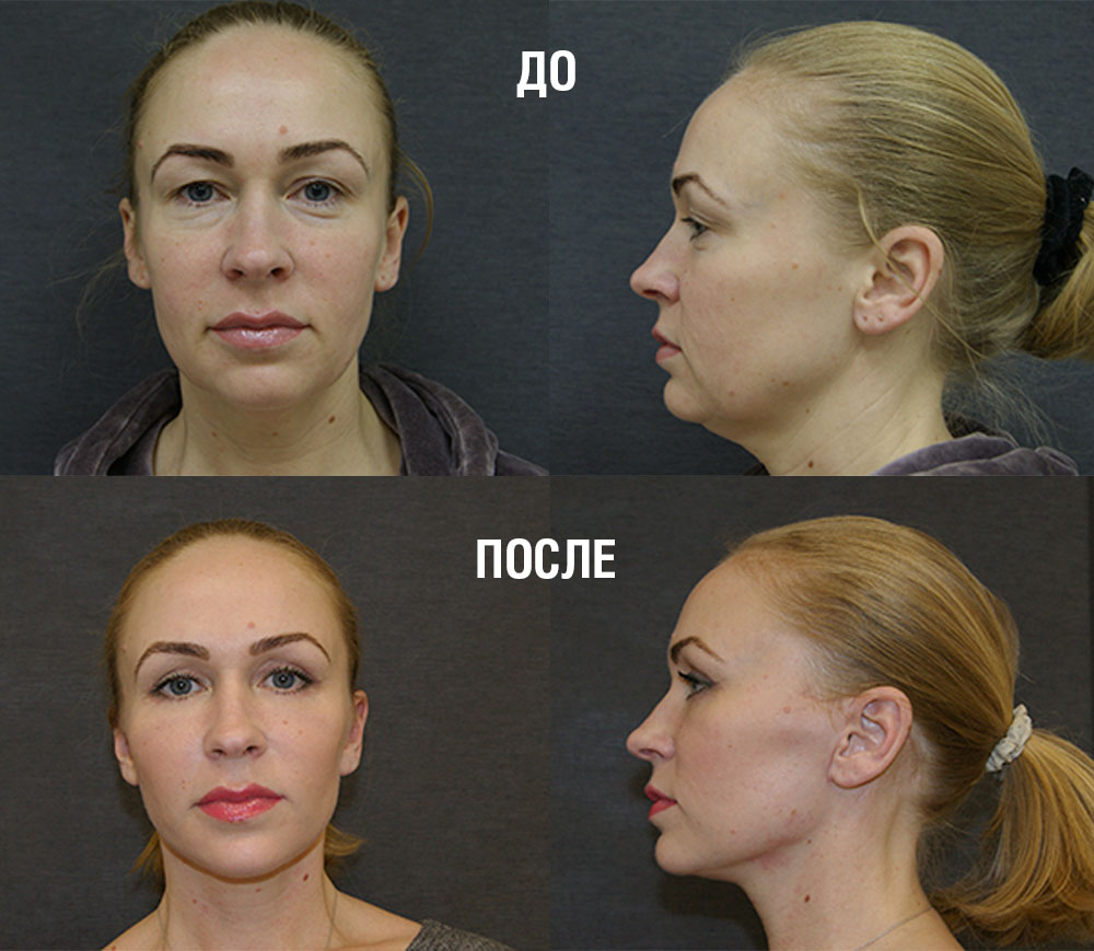 Фото до и после операции