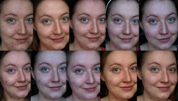 Фото до и после атравматической чистки лица