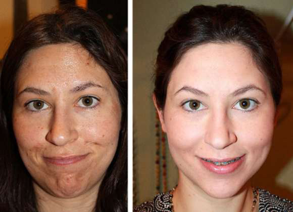 Фото до и после процедуры пилинга