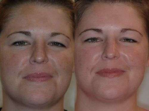 Фотографии до и после проведения срединного пилинга лица
