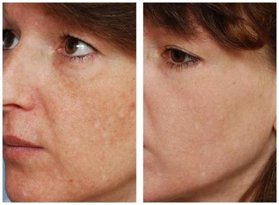 Лазерный пилинг: фото до и после очищения лица