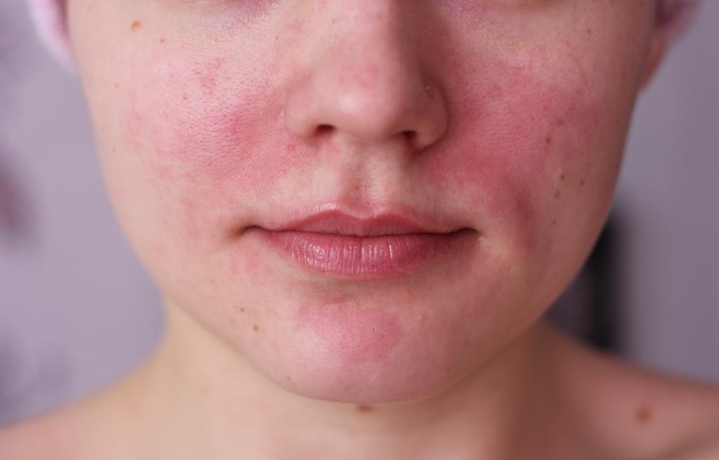 Ожог на лице после крема