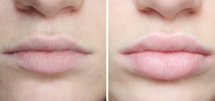 Контуринг губ гиалуроновой кислотой – какого результата можно добиться