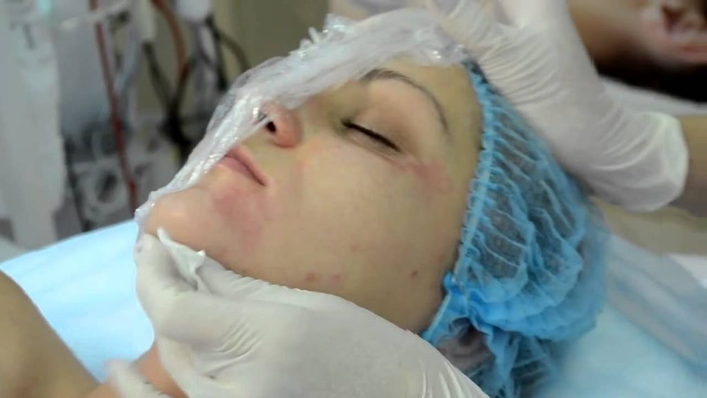 Советы косметологов, как быстро убрать синяки после мезотерапии