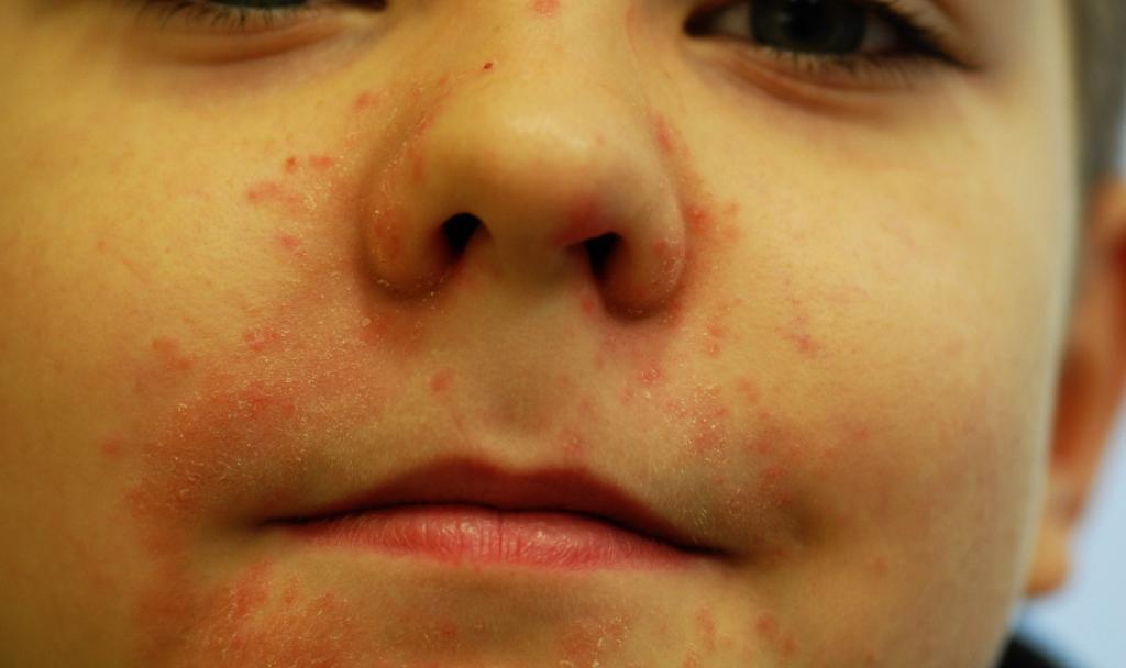 Пероральный дерматит фото на лице у женщин