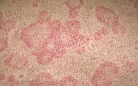 крем от аллергии на коже у взрослых негормональные