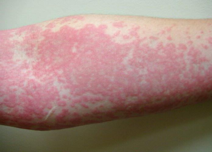 крем от аллергии на коже у взрослых отзывы