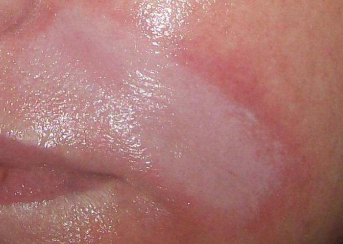 гиалуроновая кислота в губы отзывы фото