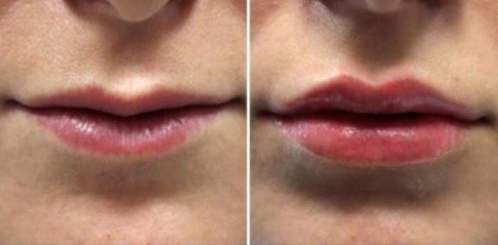 форма губ гиалуроновой кислотой